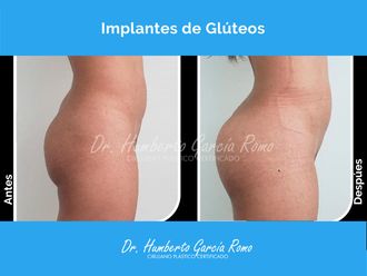 Gluteoplastia antes y después - 869834