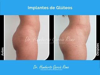 Gluteoplastia - Dr. Jorge Humberto García Romo