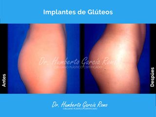 Gluteoplastia - Dr. Jorge Humberto García Romo