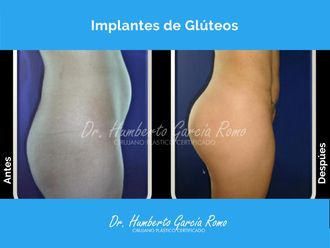 Gluteoplastia antes y después - 869836