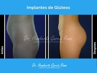 Gluteoplastia antes y después - 869837