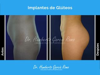 Gluteoplastia - Dr. Jorge Humberto García Romo