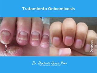 Onicomicosis - Dr. Jorge Humberto García Romo