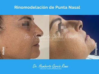 Rinomodelación antes y después - 877008