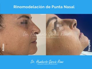 Rinomodelación - Dr. Jorge Humberto García Romo