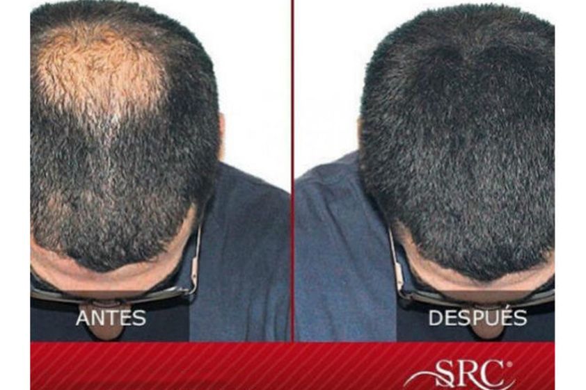 Trasplante de cabello antes y después - 812525