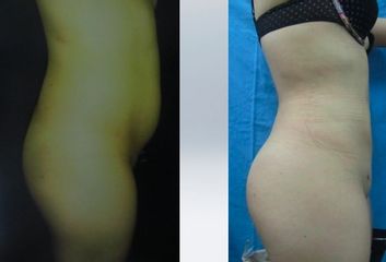 Antes y después de Aumento glúteo y mama