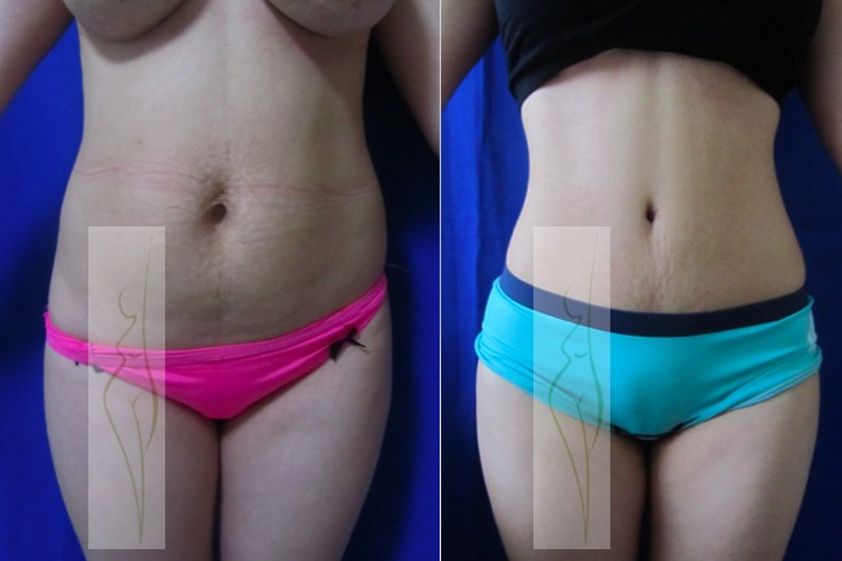 Abdominoplastia antes y después - 380464