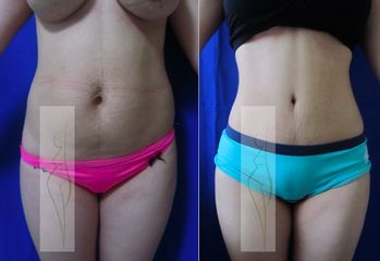 Antes y después de Abdominoplastia + liposucción