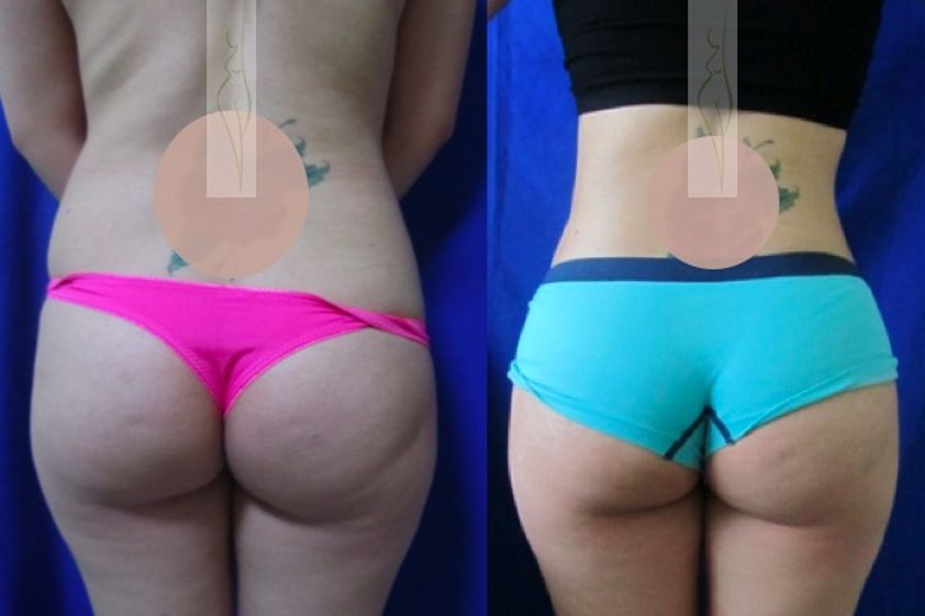 Lipoescultura antes y después - 393332