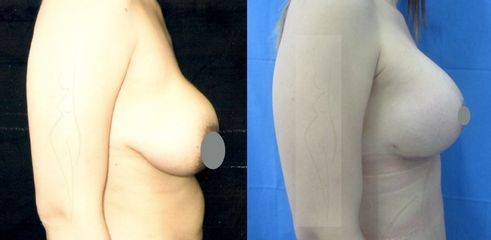 Antes y después de Mastopexia (levantamiento mama)