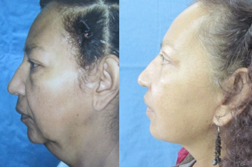 Lifting antes y después - 410967