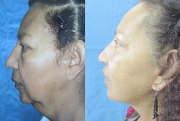 Antes y después de Ridectomía (lifting facial)