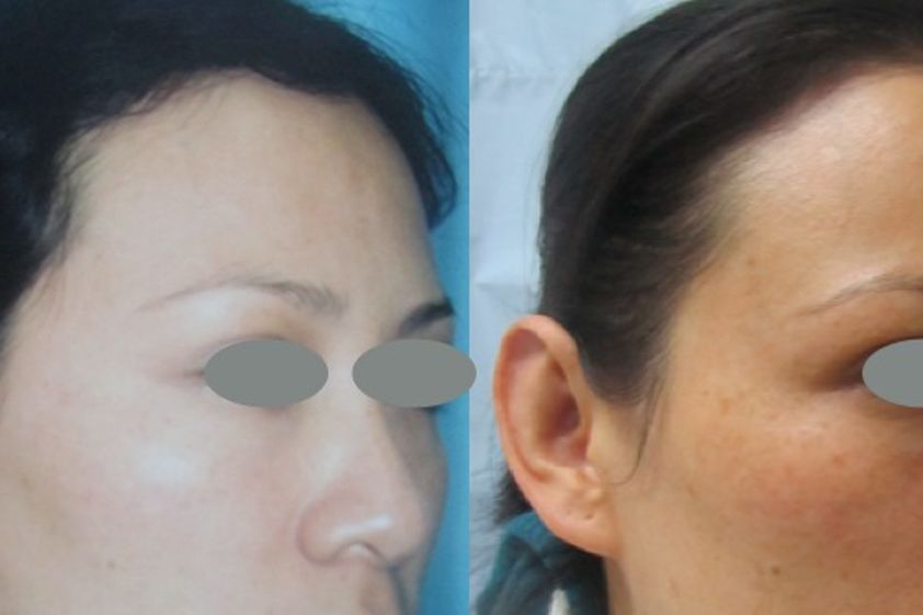 Otoplastia antes y después - 411301