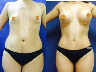 Antes y después de Abdominoplastía y aumento de mama 