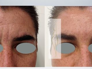 Antes y después de Toxina botulínica y rellenos faciales