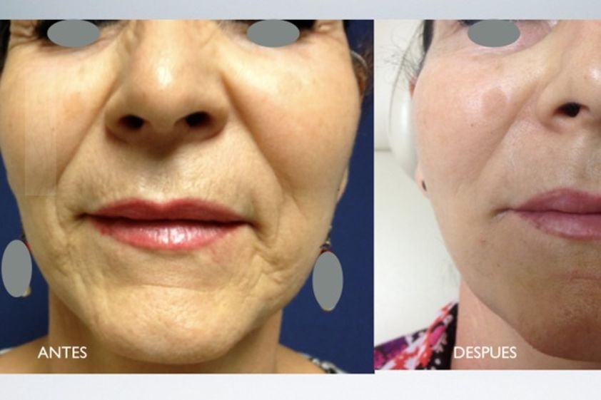 Rejuvenecimiento facial antes y después - 479776