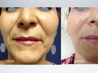Antes y después de Rejuvenecimiento facial sin cirugía