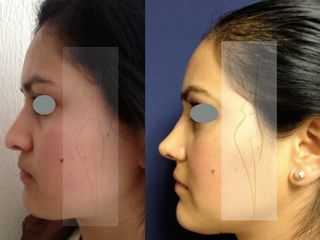 Antes y después de Rinoplastia (nariz)