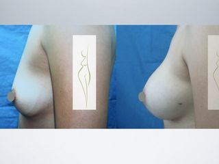 Antes y después de Mamoplastia de aumento