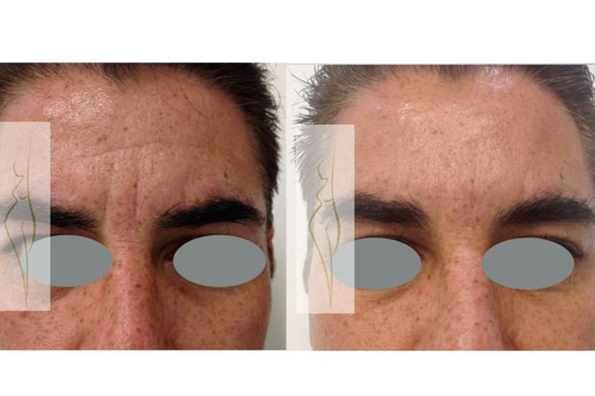 Toxina botulínica antes y después - 490442