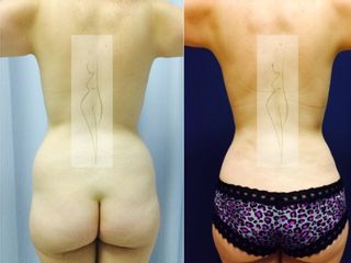 Antes y después de Lipoescultura y aumento de glúteo