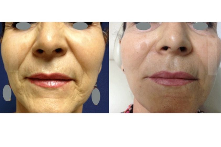 Tratamientos faciales antes y después - 497987