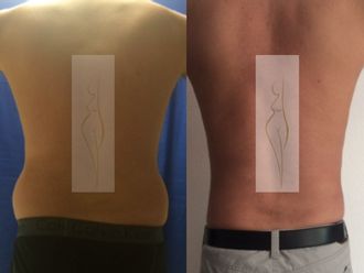 Lipoescultura antes y después - 528883