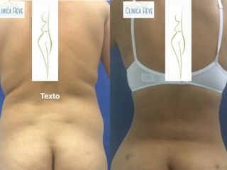 Antes y después de Lipoescultura