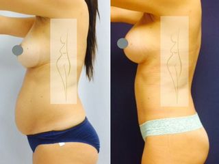 Antes y después de Mommy Makeover