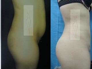 Antes y después de aumento de gluteos