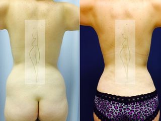 Antes y después de lipoescultura