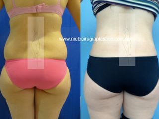 Antes y después de lipoabdominoplastia