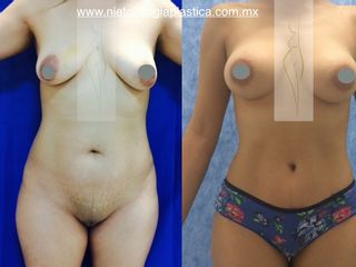 Antes y después de abdominoplastia, aumento de busto y mommy makeover