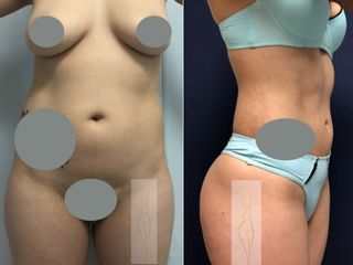 Antes y después de Lipoescultura