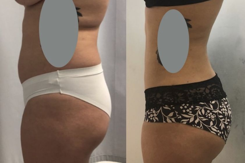 Lipoescultura antes y después - 627253