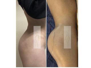 Antes y después de Implantes de glúteo