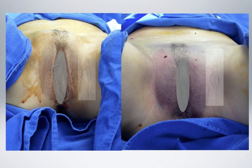 Rejuvenecimiento Vaginal antes y después - 637087