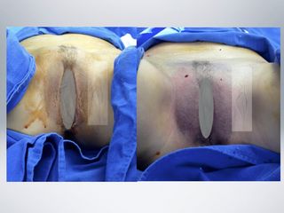 Antes y después de Rejuvenecimiento vaginal 