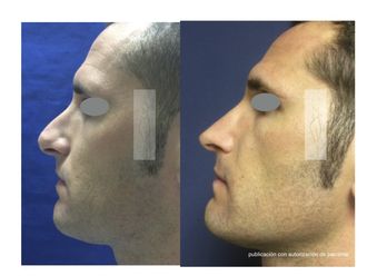 Rinoplastia antes y después - 637088