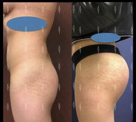 Antes y después de Implantes de glúteo