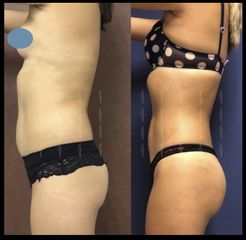 Antes y después de Gluteoplastia