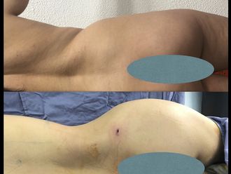 Gluteoplastia antes y después - 835854