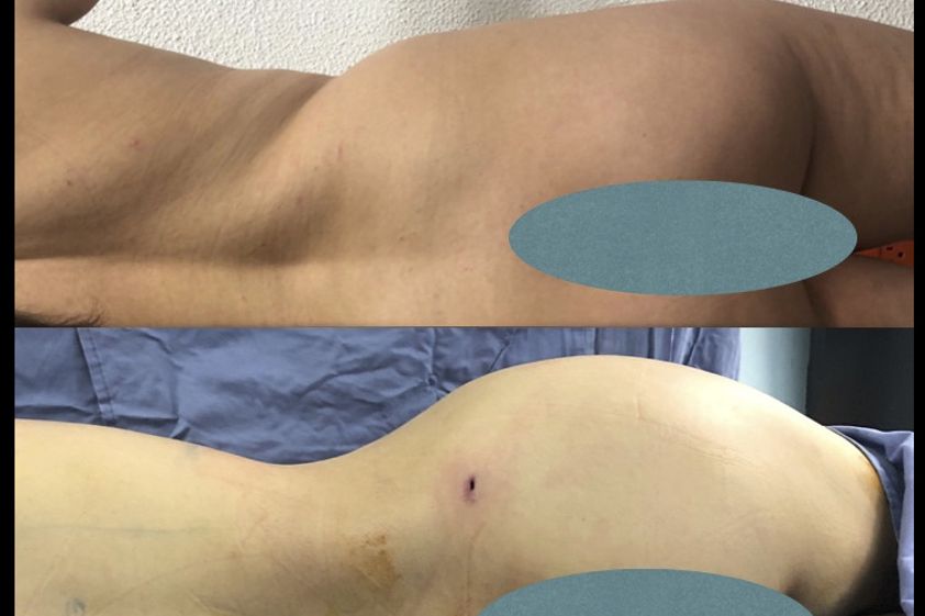 Gluteoplastia antes y después - 835854
