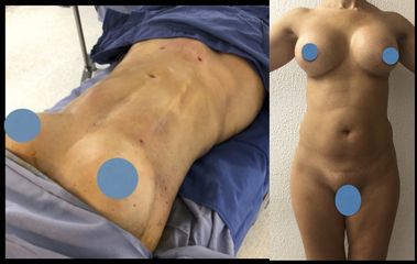 Marcaje abdominal lipoescultura - Dr. Rubén Nieto Balcázar