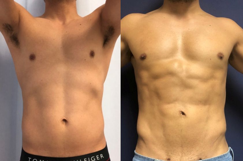 Liposucción antes y después - 848373