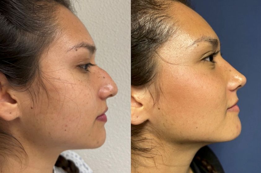 Rinoplastia antes y después - 848374