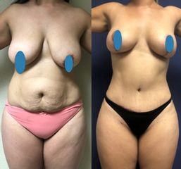 Lipoescultura - Dr. Rubén Nieto Balcázar