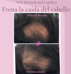 Alopecia - Dra. Lena Ferreiro