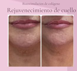 Rejuvenecimiento facial - Dra. Lena Ferreiro